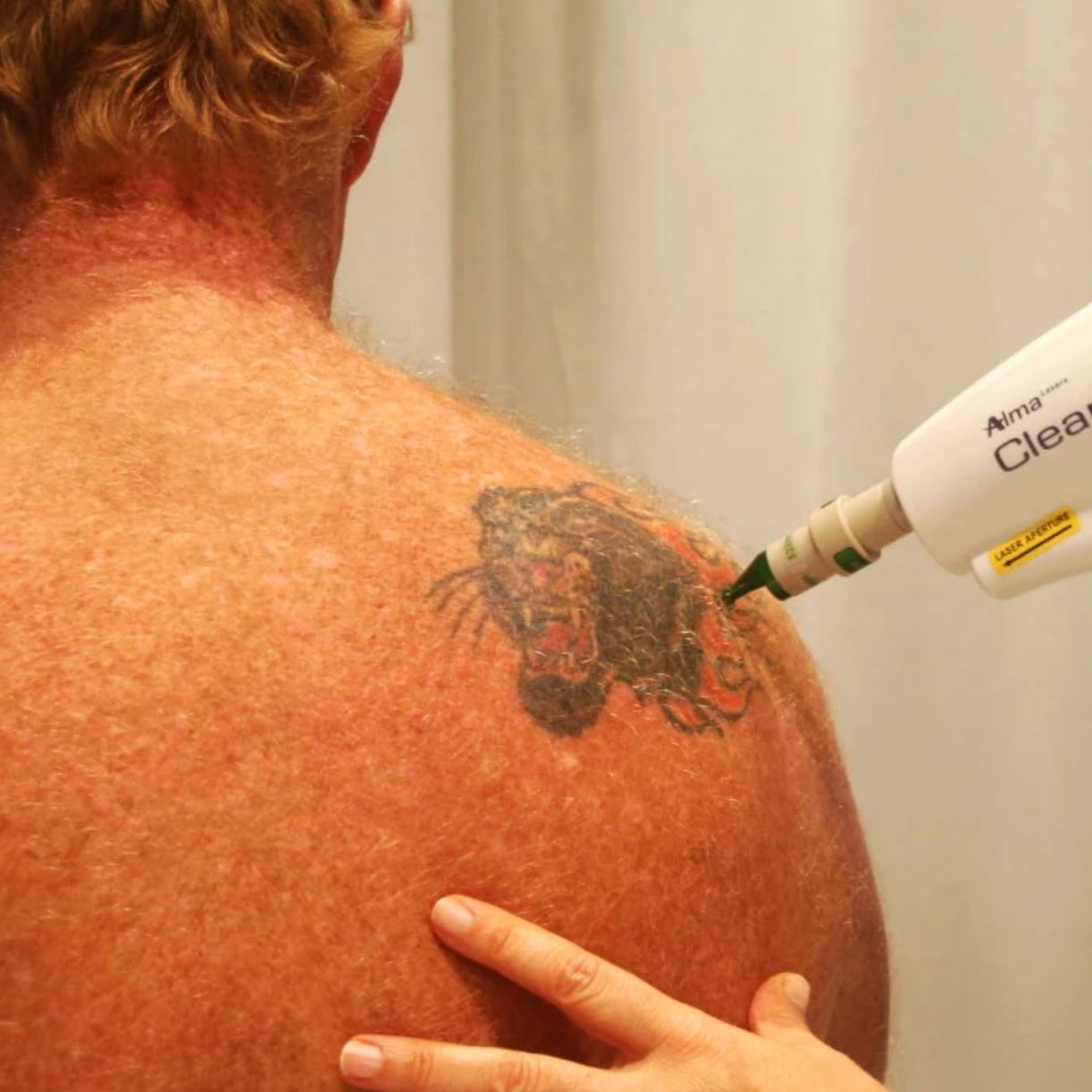Tattoo Removal Miami | Non-Invasive & Effective Treatment