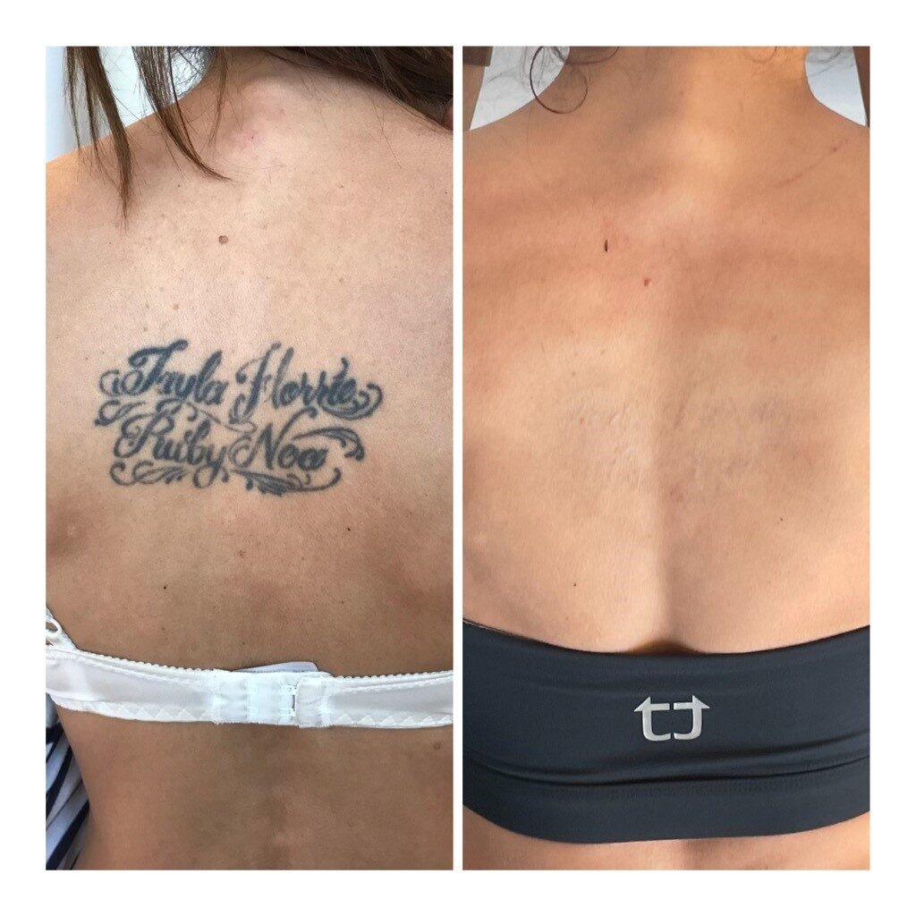 Tattoo Removal  Lé Grand Medispa